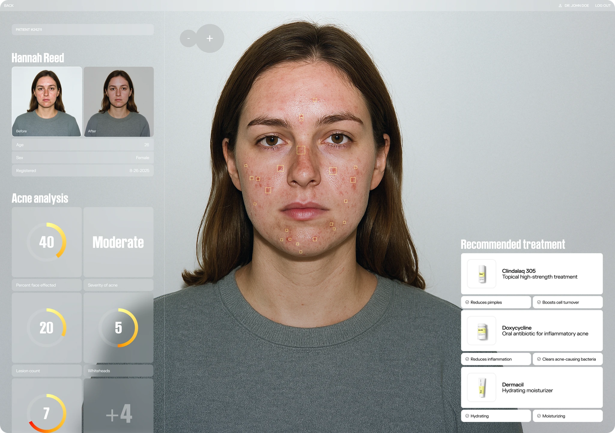 Acne Before