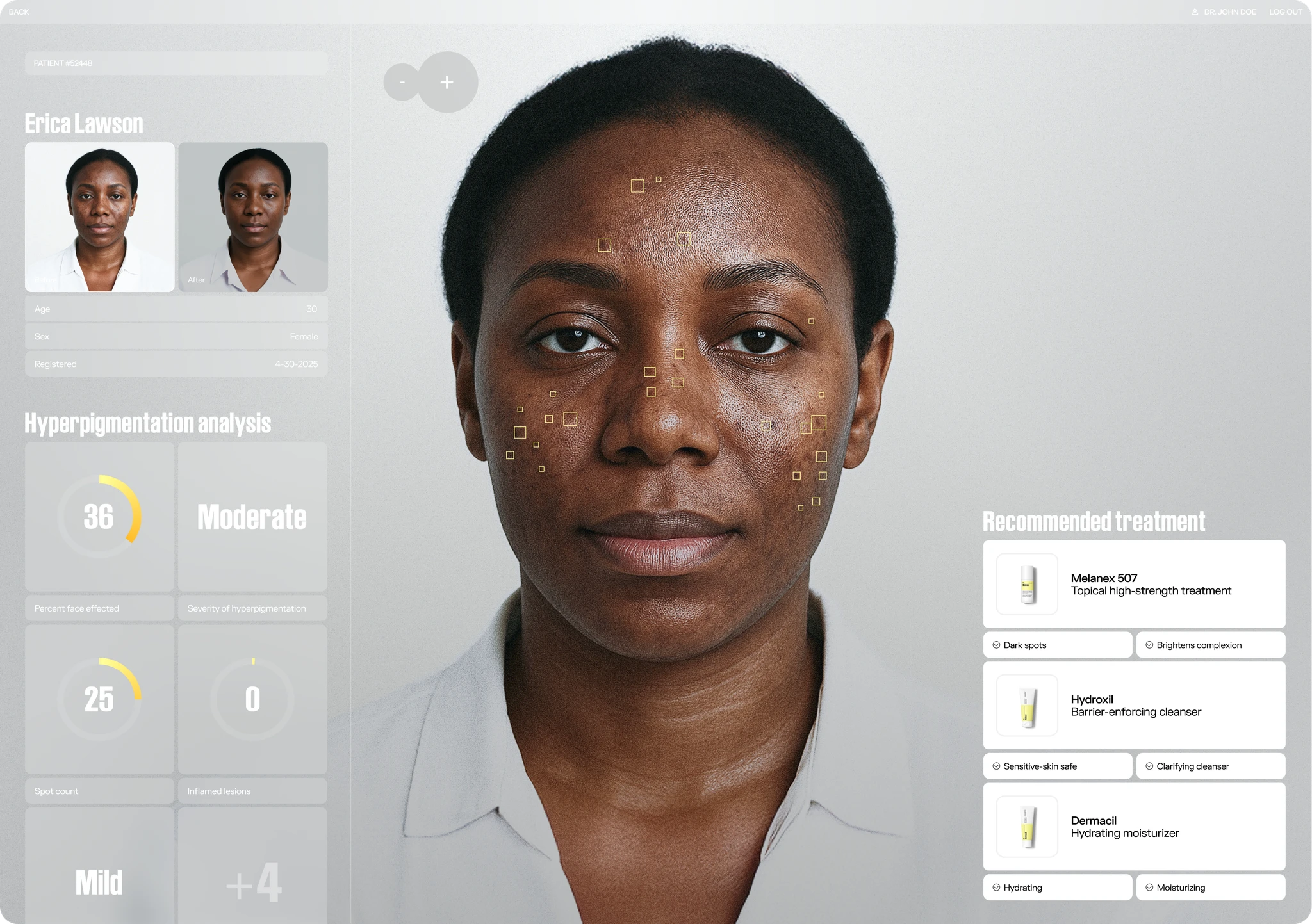 Hyperpigmentation Before